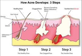 Hoạt chất trị thâm nám Acnebuster